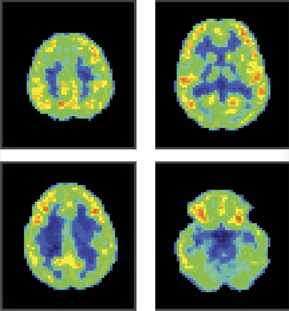 Image of PET image of a human brain not focused on a specific task or object