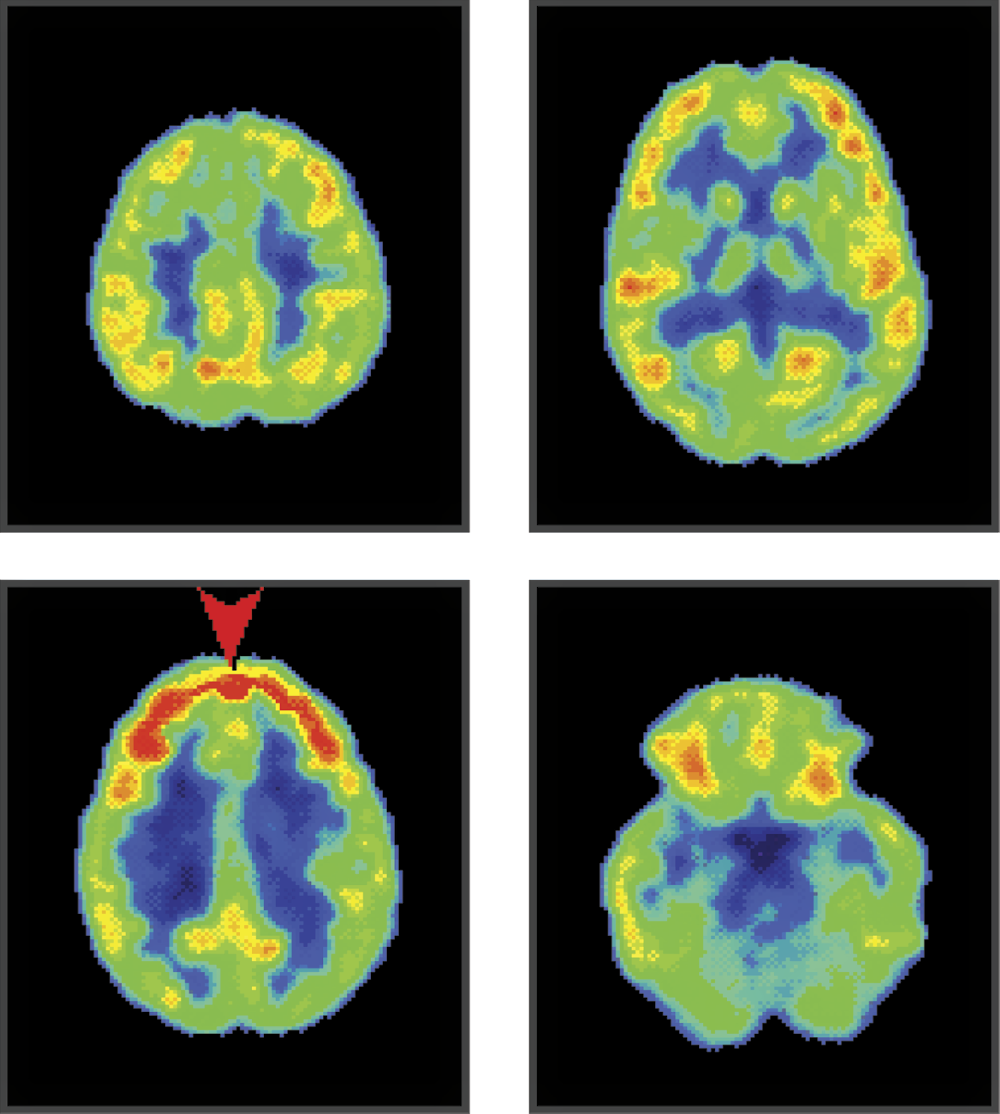 Image of PET image of a human brain focused heavily on a mathematical equation