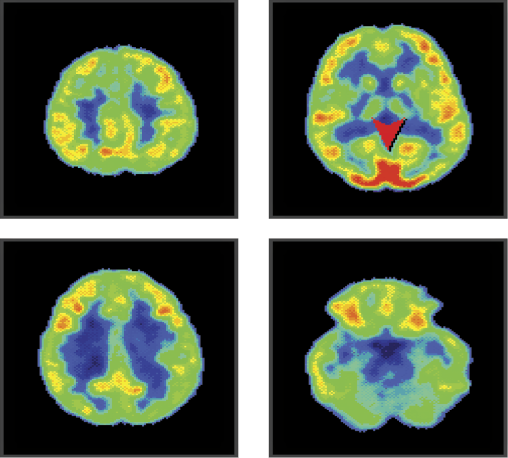 Image of PET image of brain activity while a subject watches something interesting