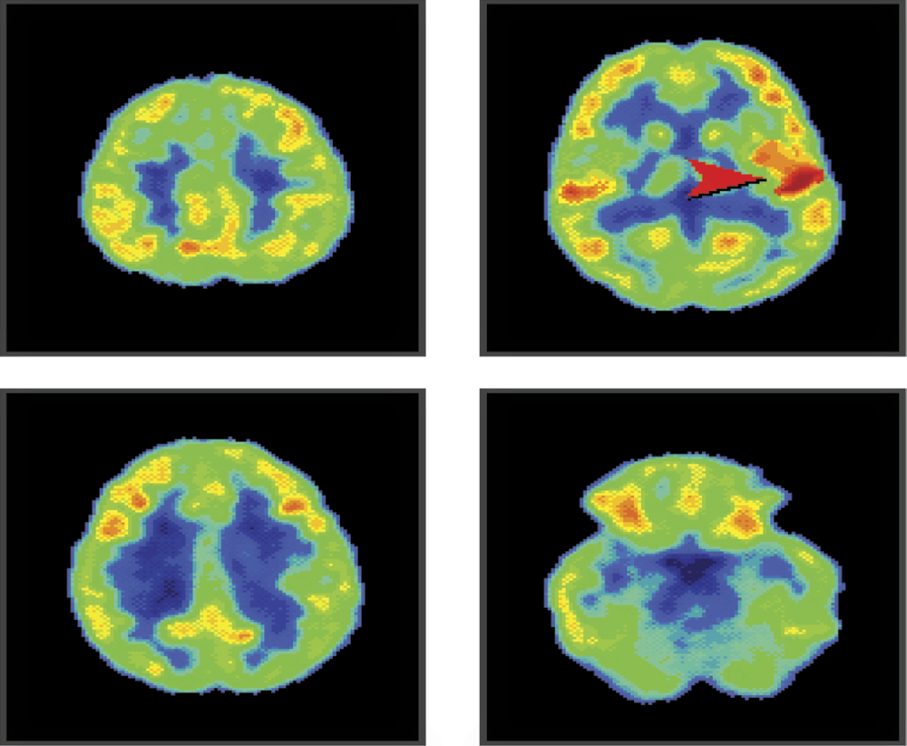 Image of Listening to a conversation activates mostly temporal lobes because they are responsible for signal analysis