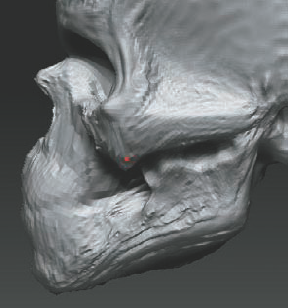 Cheekbone hollow pulled back into the head