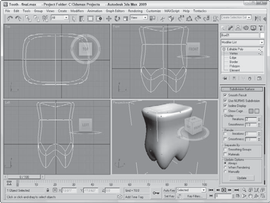 The organic look for this tooth is accomplished with NURMS.