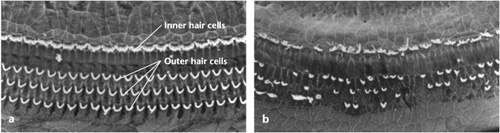 Scanning electron micrographs of healthy and damaged stereocilia. (a) In the normal cochlea, the stereocilia of a single row of inner hair cells (top) and three rows of outer hair cells (bottom) are present in an orderly array. (b) In the damaged cochlea, there is disruption of the inner hair cells and loss of the outer hair cells. This damage produced a profound hearing loss after exposure to 90 dBA noise for eight hours six months earlier. Although these micrographs are of the organ of Corti of a lab rat, they serve to demonstrate the severe effects of overexposure to loud sound. (The “A” in the dB value refers to the filter used for measuring frequency response that bears a close resemblance to the response of the human ear.)