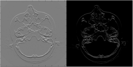 Figure showing some more results from Example 5.4.3. The left image shows the effects of Kx-forward on the SKULLBASE.DCM-image. It is pretty evident why this filter is also called the bas-relief filter. When computing the absolute value of the convolution of Kx-forward with SKULLBASE.DCM, the image on the right is produced. It does always give a positive value, no matter whether the image edges change from bright to dark pixel values or vice versa. In can also be seen that vertical edges like the skin surface close to the zygomatic arch is not emphasized; the x- and y-axis are swapped - this is a direct consequence of the matrix indexing conventions in MATLAB, where the first index is the column of the matrix image. Image data courtesy of the Dept. of Radiology Medical University Vienna.