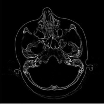 Figure showing the result of applying a Sobel-filter to SKULLBASE.DCM. The reader is encouraged to compare this image to the corresponding image in Figure 5.8. Image data courtesy of the Dept. of Radiology Medical University Vienna.