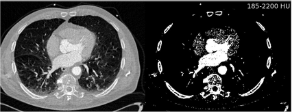Figure showing a segmentation example on a CT slice of the human heart. By defining an appropriate threshold, a binary image is created. The binary image contains, besides the bone and the contrast enhanced part of the heart, also parts of some large vessels in the lung and parts of the patient table. A full segmentation of the heart (or of parts of it containing contrast agent) without these additional structures is not possible by thresholding. Image data courtesy of the Dept. of Radiology, Medical University Vienna.