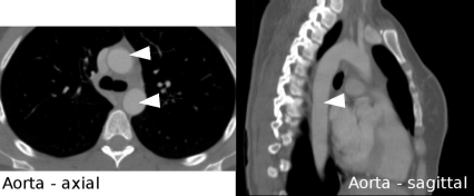 Figure showing an illustration of typical problems encountered when dealing with 3D segmentation problems. The aorta in these CT images (indicated by white arrows) appears as a single structure in the right slice, which is reformatted in a sagittal orientation, whereas it shows up as two circles in the left axial slice. Image data courtesy of the Dept. of Radiology, Medical University Vienna.