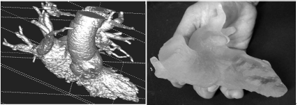 Figure showing the result of the segmentation using ITKSnap after rendering (image on the left). The contrast agent’s distribution mirrors the disease of the patient; he suffers from severe heart insufficiency, which causes little transport of the arterial blood and the contrast agent. Therefore, venous structures are also partially segmented. This 3D surface model can be “cleaned up” and smoothed using morphological operations, and transformed to a surface model – these techniques will be introduced in a later chapter. Once a triangulated surface model is available, the model can be printed using a 3D stereo lithographic printer. This tangible 3D model is shown in the photograph on the right.