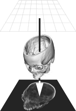 Figure showing orthogonal raycasting consists of projecting a beam emanating from a grid parallel to the image plane; the ray determines the appearance of the pixel it aims at on the imaging plane. If a volume rendering algorithm is implemented using raycasting, it integrates the voxel values using a defined transfer function. In the most simple case, this function is a simple max-function; only the most intense voxel is returned and conveyed to the pixel on the rendered image. This rendering technique is called maximum intensity projection (MIP). Image data courtesy of the Dept. of Radiology, Medical University Vienna.