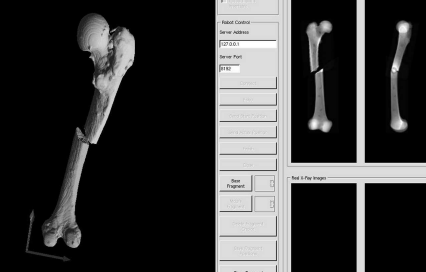 Figure showing a screenshot of software for simulating long bone fractures. The user can apply an arbitrary fracture to a model of a bone derived from CT. The manipulation of the fragments in 3D is visualized using triangulated mesh models shown in the left part of the image. A collision detection algorithm, which keeps the fragments from intersecting each other, is also implemented. Meanwhile, simulated lateral and anterio-posterior DRRs are rendered as well from a smaller version of the original CT-volume (right hand side). The purpose of this training tool was to provide a simple demonstration for the context of 3D manipulation of bone fragments and the resulting x-ray images.