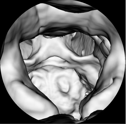 Figure showing a virtual endoscopy of the spinal canal of the pig dataset, rendered from CT. Basically speaking, this is a surface rendering that, in addition, simulates the barrel distortion induced by the wide angle optics of a conventional endoscope. Image data courtesy of the Dept. of Radiology, Medical University Vienna.