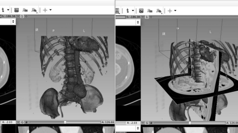 Figure showing a rendering from 3DSlicer with the “CT-Bones” preset, with and without the slices from the orthogonal views visible.