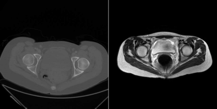 Figure showing two slices of the same patient at the same location, the hip joint. The left image shows the CT image, the right image is taken from the MR scan. Differences in the field-of-view and patient orientation are evident. Registration algorithms compensate for these discrepancies by finding a common frame of reference for both volume datasets. Image data courtesy of the Dept. of Radiology, Medical University Vienna.