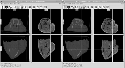 Figure showing two screenshots from the registration tool of AnalyzeAVW. On the left side, we see two slices of the MR and the CT scan, unregistered. Gross orientation is similar, but discrepancies are clearly visible. Besides soft tissue deformation, it is also evident that rigid structures such as the calvaria of the well-known pig scan do not coincide. After initiating the registration algorithm (in this case, an implementation of normalized mutual information), the two images match. The resulting volume transformation matrix V can be seen in Figure 9.4. Image data courtesy of the Dept. of Radiology, Medical University Vienna.