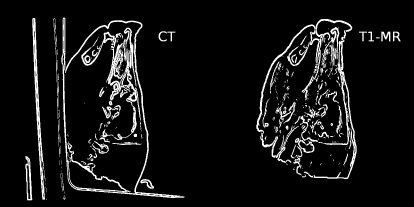 Figure showing cT.jpg and T1.jpg after Sobel-filtering, optimization of image depth and thresholding. After this process, the differences in gray values in the two images disappear, and only gradient information remains. Applying a gradient-based measure to such an image allows for multi-modal image registration without computing joint histograms or using an intensity based measure.