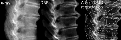 Figure showing three images of a spine reference-dataset for 2D/3D image registration. We see the reference x-ray on the left, the DRR generated from the initial guess, and the registration result. An edge image of the x-ray is overlaid over the final DRR after 2D/3D registration.