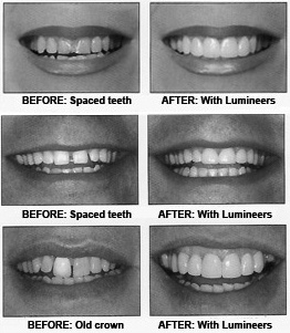 Before and after shots for a cosmetic dentistry site