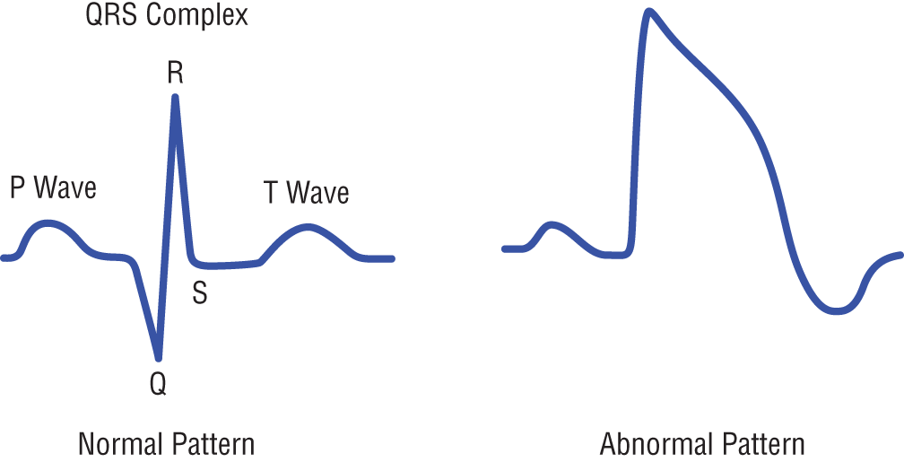 Schematic illustration of an electrocardiogram pattern showing normal and abnormal heartbeats.