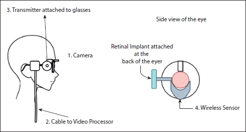 Schematic illustration of the working of Argus II retinal implant.