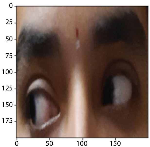 Schematic illustration of left gaze.