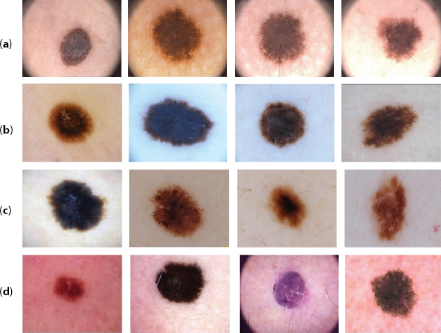 Photographs of the sample skin lesion images from public dataset.