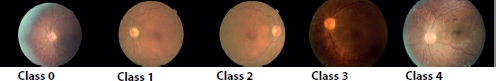 A photograph of the retinal images of DR in their order of increasing severity. 