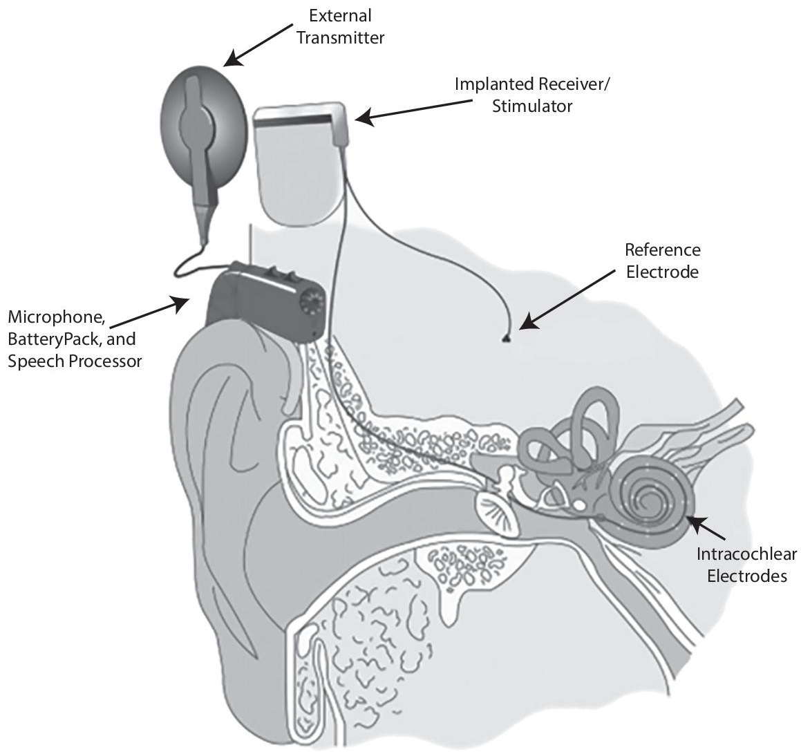 Schematic illustration of cochlear BMI.