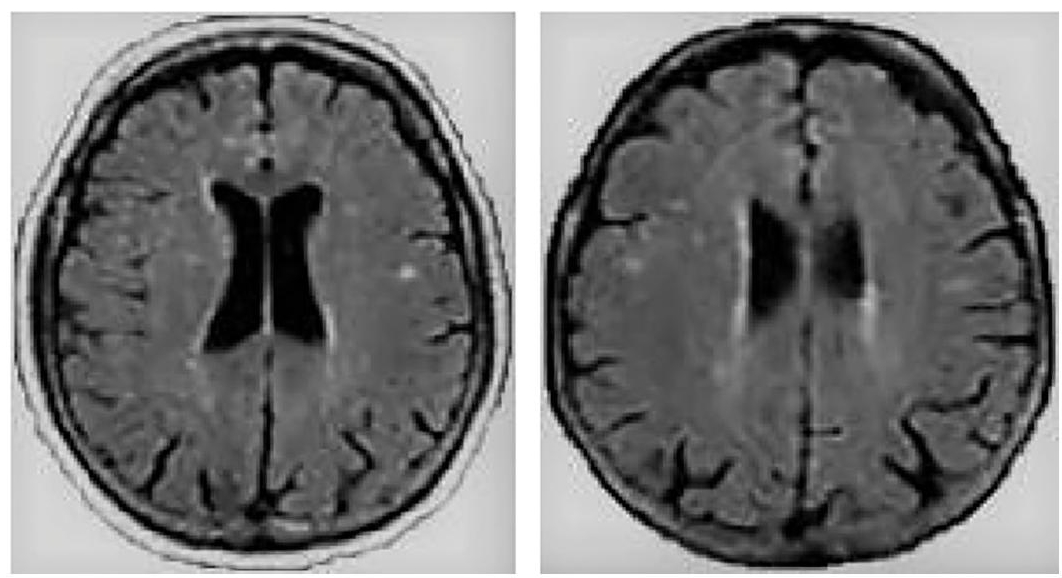 Schematic illustration of rsfMRI bipolar disorder image.