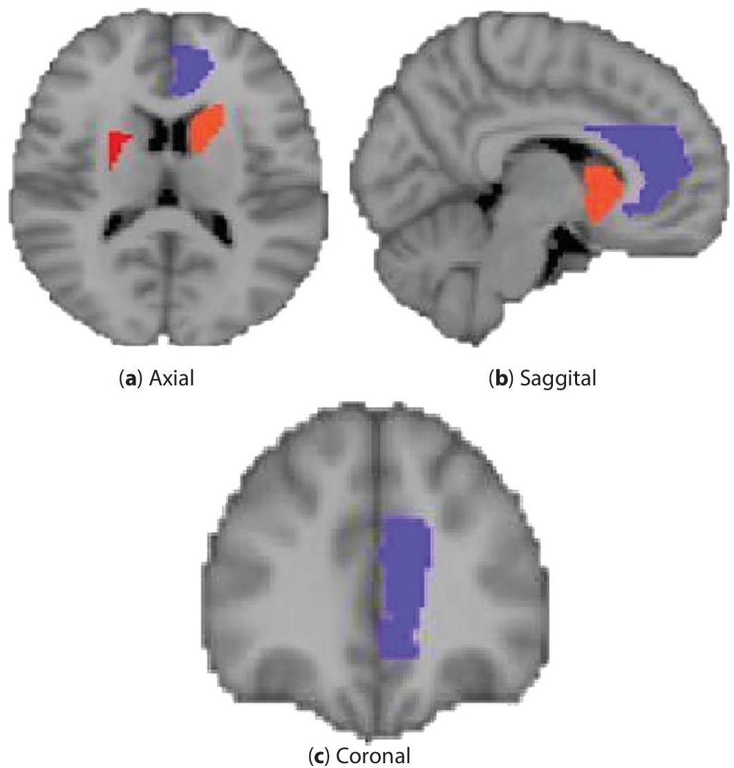 Schematic illustration of rsfMRI of schizophrenia.