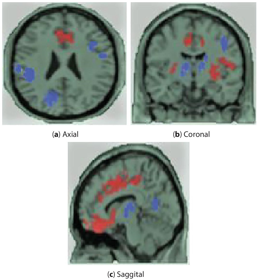 Schematic illustration of rsfMRI image of ADHD.