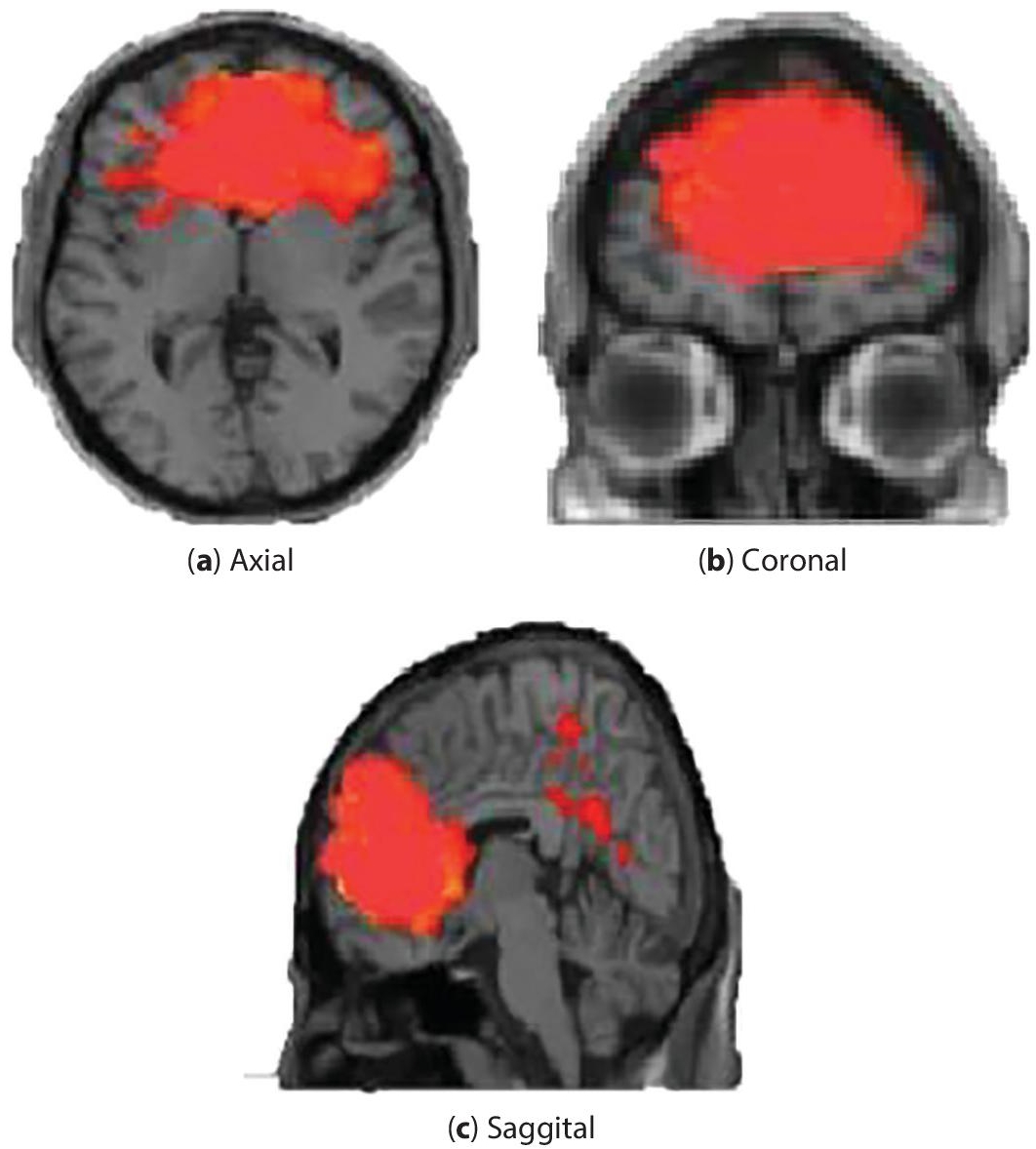 Schematic illustration of rsFMRI of infant brain.