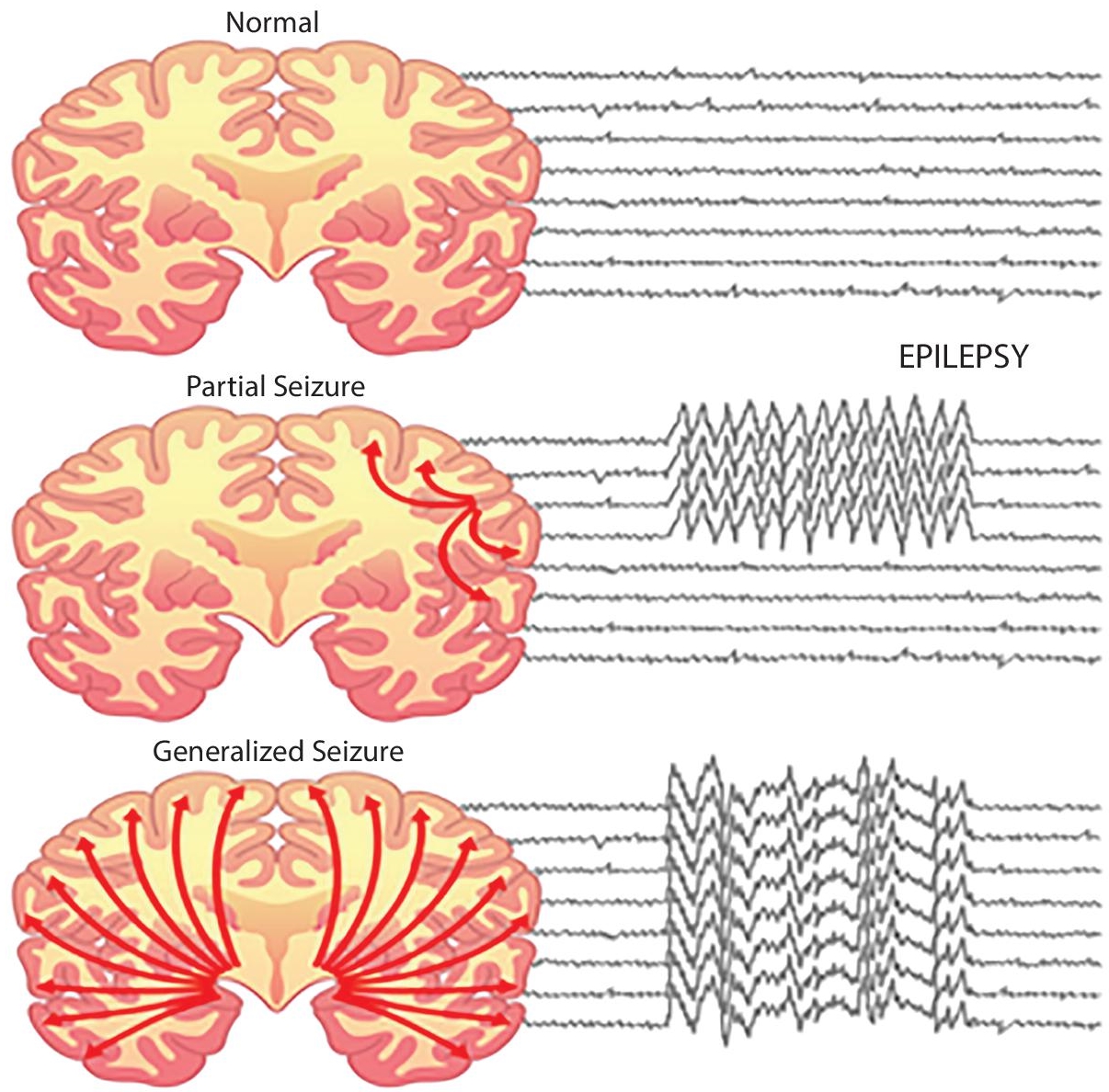 Schematic illustration of seizure identification.