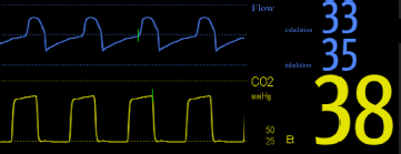 Graph depicts the flow and capnogram.