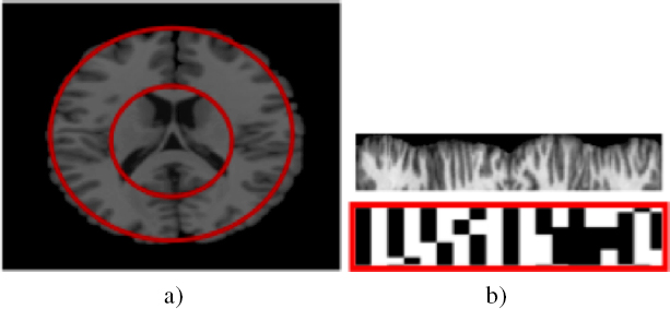 Schematic illustration of brain biometry via MRI.
